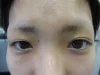 二重瞼（埋没法）の術前