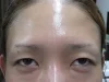 二重瞼（埋没法）の注射前
