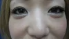 眼の下の二重の術後