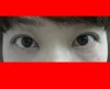 二重瞼（埋没法）の術後