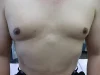 乳頭縮小（男性）