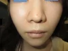鼻翼縮小の術後