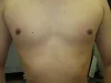 乳頭縮小（男性）の術後