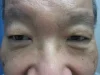 眼瞼下垂の術前
