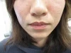 口唇　ヒアルロン酸の施注前