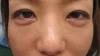 眼の下の二重の術後