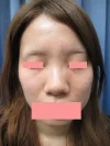 隆鼻術（プロテーゼ）の術前