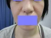 鼻翼縮小の術後