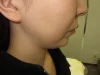 二重あごの治療（顎下の脂肪摘出術）の術前