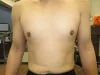 乳頭縮小（男性）の術前