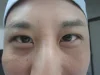 二重瞼の施術後