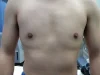 乳頭縮小（男性）の術後