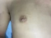 乳頭縮小（男性）の術後